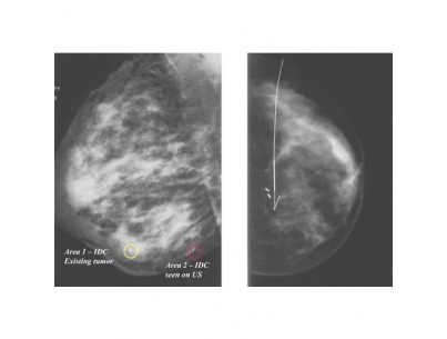 Permanent invasive breast site markers 