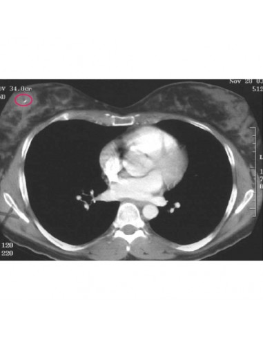 Marqueur de site mammaire Biomarc 13G 11cm Marqueur de site mammaire Biomarc 13G 11cm