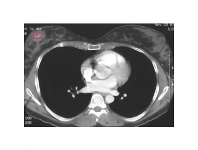 Biomarc 14G 11cm breast tissue marker