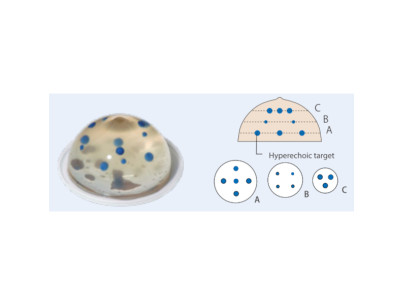 Jeu de deux fantômes de sein 2 fantômes transparents pour simulation de biopsie sous échographie