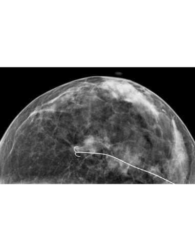 Breast Localization D wire - 18G x 7.5cm (box of 10) Breast Localization D wire - 18G x 7.5cm (box of 10)