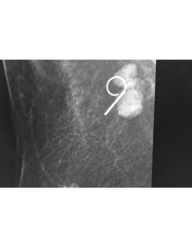 Repositionable breast Localization wire 20G x 10cm / box of 10 Retractable hook unic flexibility Repositionable breast Localization wire 20G x 10cm / box of 10 Retractable hook unic flexibility